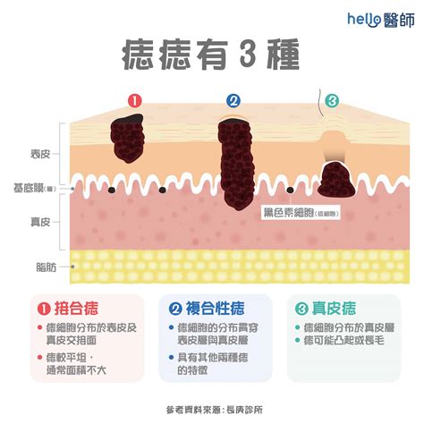 臉上的痣|痣變大、痣多或長毛會變皮膚癌？認識痣的形成與原因